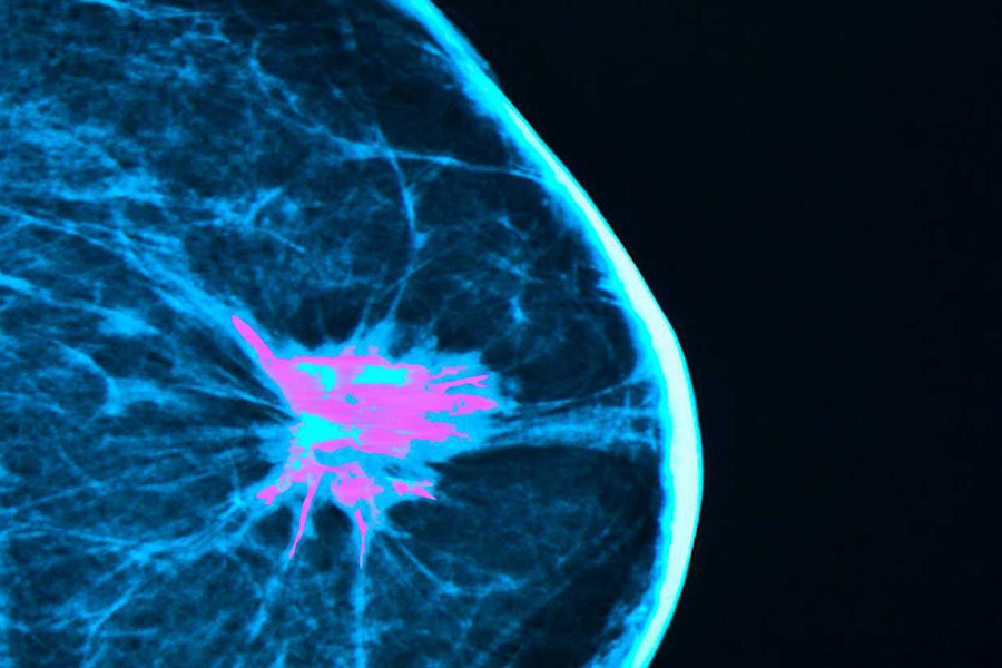 image of a breast scan